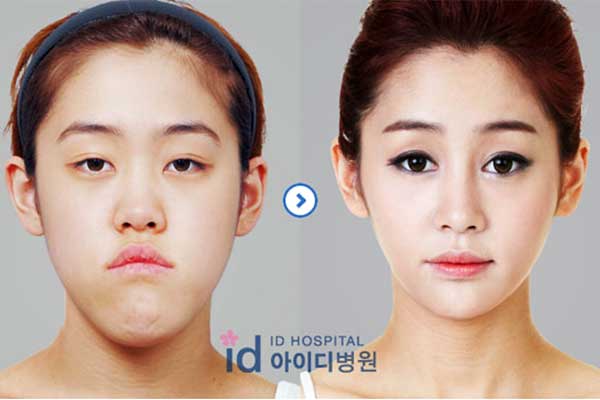 Frauen im asiatischen Raum vor- und nach einer Beauty-OP