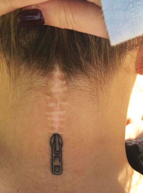 Ein Reißverschluss-Tattoo ziert die Narbe einer Frau