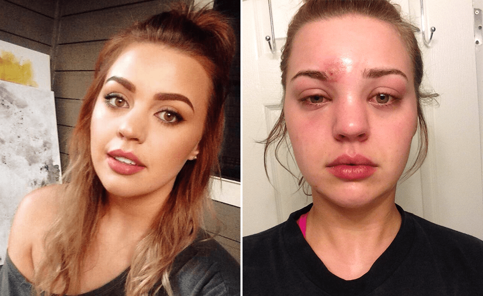 Mädchen mit Staphylokokken-Infektion wegen eines dreckigen Make-up-Pinsels